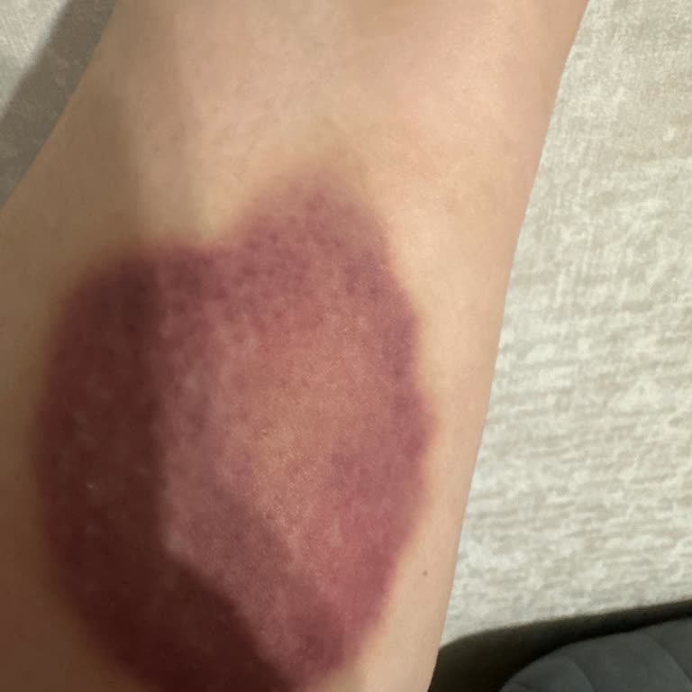 Serum Takma Hatası Nedeniyle Şiddetli Morarma Ve Ücret İadesi Talebi