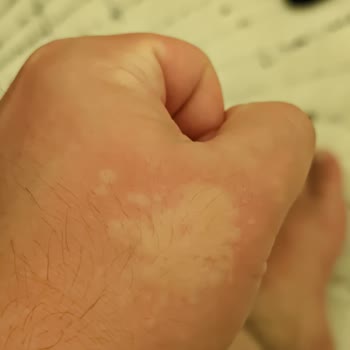 Palmolive Duş Jelinde Şiddetli Kaşıntı Ve Yetersiz Çözüm