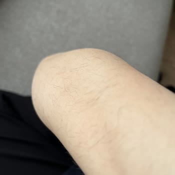 Aris Vip’te Lazer Epilasyonda Yanık Ve Kıl Artışı, Mağduriyet Ve Ücret İadesi Talebi