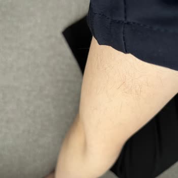 Aris Vip’te Lazer Epilasyonda Yanık Ve Kıl Artışı, Mağduriyet Ve Ücret İadesi Talebi