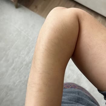 Aris Vip’te Lazer Epilasyonda Yanık Ve Kıl Artışı, Mağduriyet Ve Ücret İadesi Talebi