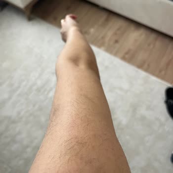 Aris Vip’te Lazer Epilasyonda Yanık Ve Kıl Artışı, Mağduriyet Ve Ücret İadesi Talebi