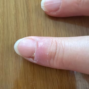 Hijyen Eksikliği Nedeniyle Manikür Sonrası Tırnak İltihabı Ve Ücret İadesi Talebi