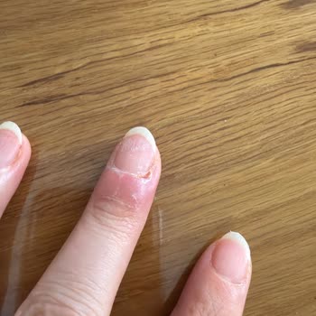 Hijyen Eksikliği Nedeniyle Manikür Sonrası Tırnak İltihabı Ve Ücret İadesi Talebi