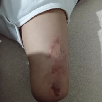 Acil Protez Yardımı Başvurusu Arşive Alındı, Bilgi Ve İletişim Eksikliği