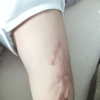 Acil Protez Yardımı Başvurusu Arşive Alındı, Bilgi Ve İletişim Eksikliği