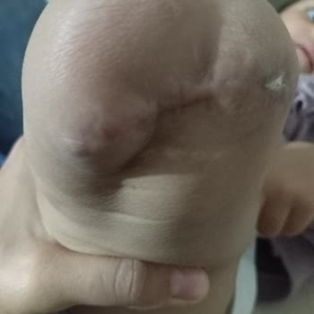 Acil Protez Yardımı Başvurusu Arşive Alındı, Bilgi Ve İletişim Eksikliği