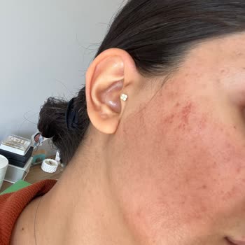 Yanlış Uygulanan Yüksek Doz Lazer İşlemi Sonrası Kılcal Damar Genişlemesi Ve İlgisiz Hizmet