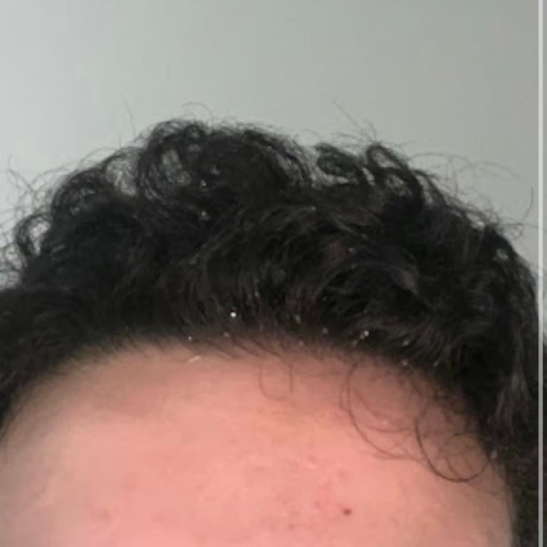 Ciltte Şiddetli Tahriş Ve Enfeksiyon Nedeniyle Watsons Şirketine 1.369,80 TL İade Talebi