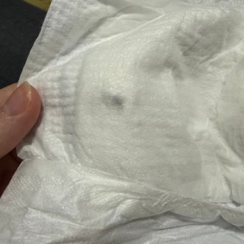 Molfix Bebek Bezinde Yabancı Cisim Görülmesi Korkutucu Güven Sorunu