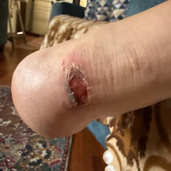 Ayak Yaralayan Botta İade Reddi