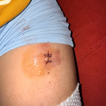 Duşakabin Patlaması Çocuğu Yaraladı Ve Şirketin Saygısız Tutumu