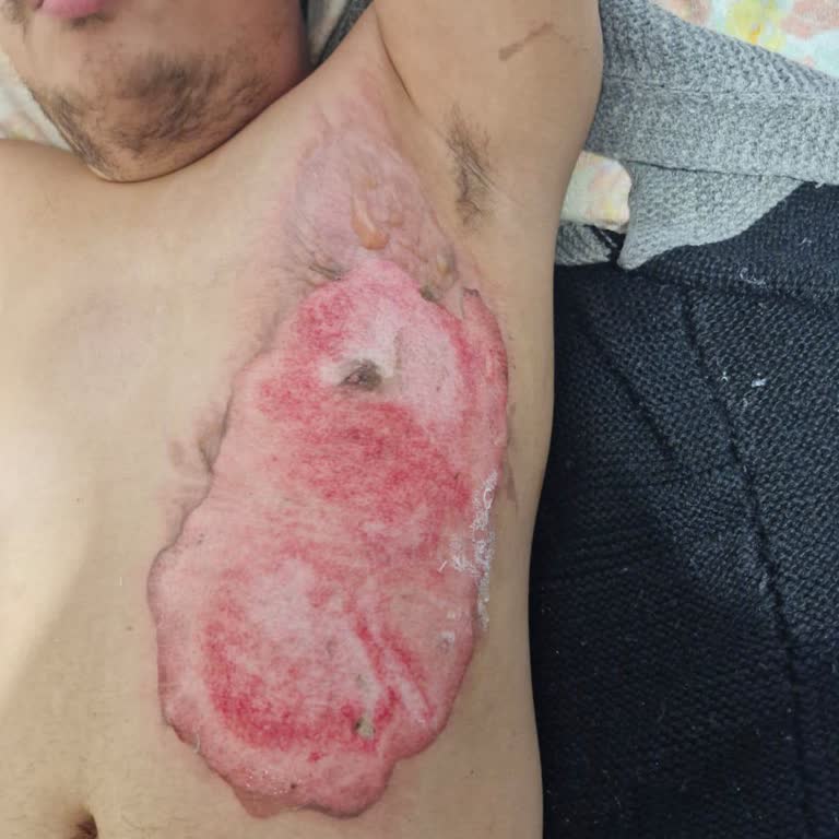 Bayındır Söğütözü Hastanesi Acil Servisinde Yanık Tedavisi İhmali Ve Ücret İadesi Talebi