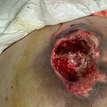 Memorial Hastanesi Memorial Ataşehir Hastanesi'nde Yoğun Bakımda Yanıltıcı Bilgi Ve Yara İhmal