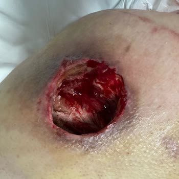 Memorial Hastanesi Memorial Ataşehir Hastanesi'nde Yoğun Bakımda Yanıltıcı Bilgi Ve Yara İhmal