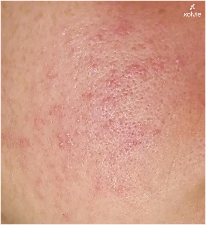 Red Mask Rash On Face
