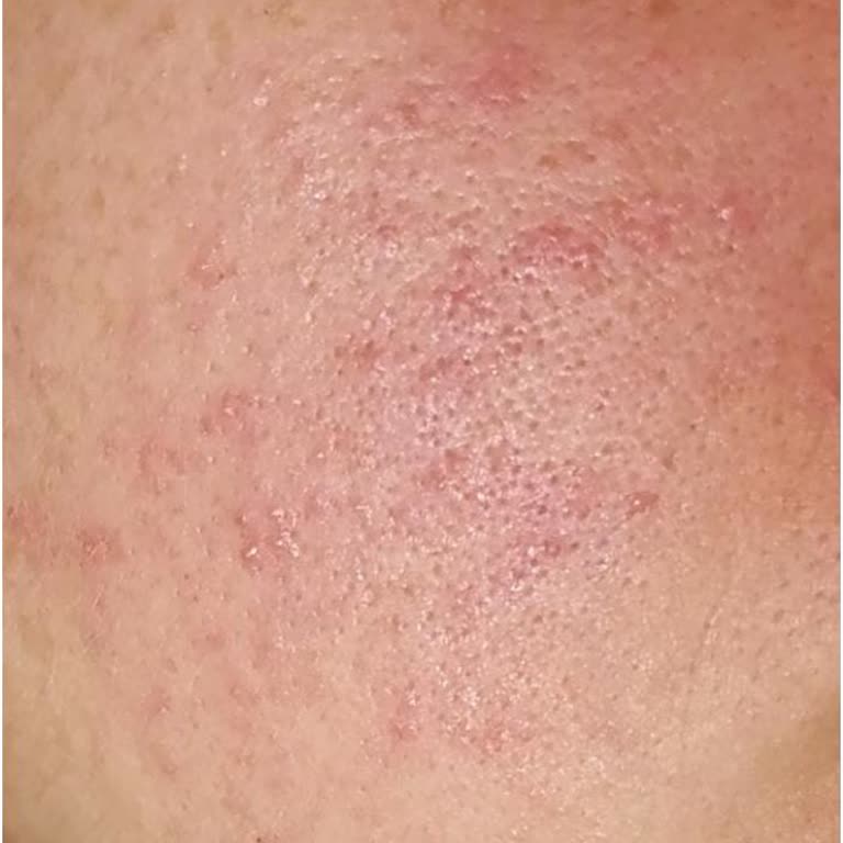 Missha Sheet Mask Caused Burning and Possible Chemical Burn on My Face