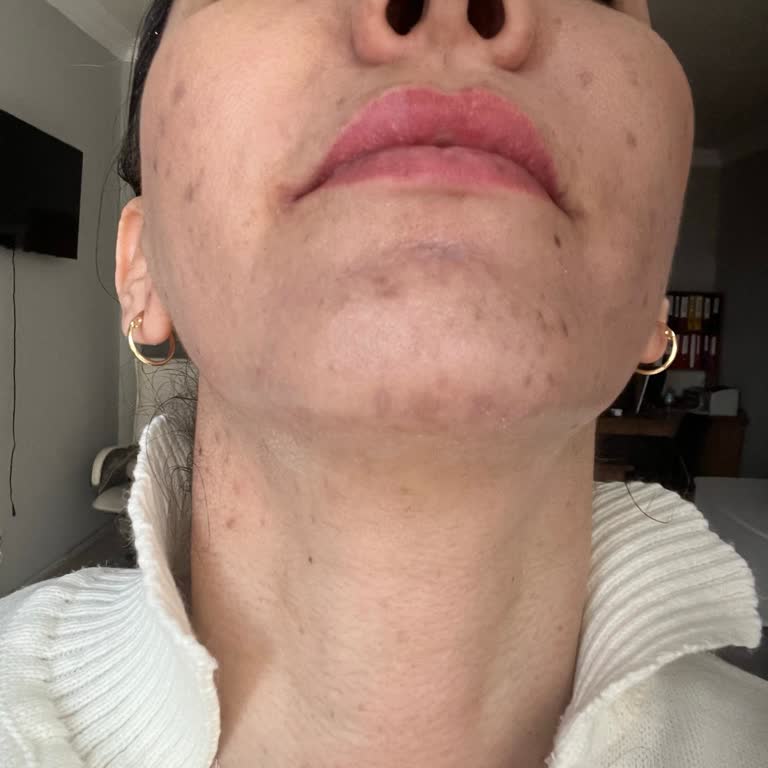 Cilt Bakımında Yanık Ve Yeni Leke: 24 Bin TL'lik Mağduriyet