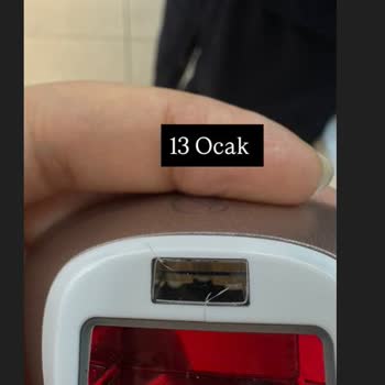 Philips Lumea IPL Cihazının Çatlak Başlığı Ve Uzayan Servis Süreci