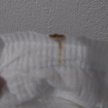 Molfix Bebek Bezinde Sertleşmiş Yağ Şikayeti