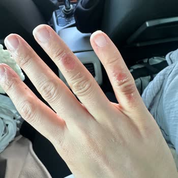 Gebze Karaköy Fırın’da Çaydanlık Yanığı Ve Güvenlik İhmali