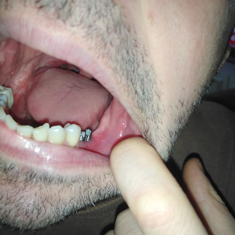 İmplantın Tekrar Düşmesi Ve 70 Bin TL’lik Ödeme Sonrası Güven Kaybı