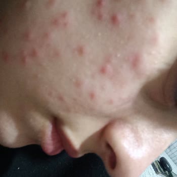 Neutrogena Yoğun Bakım Kremi Nedeniyle Alerjik Reaksiyon Ve Ücret İadesi Talebi