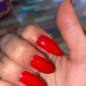 Ağrılı Yanlış Tırnak Kesimi Ve İlgisiz Personel