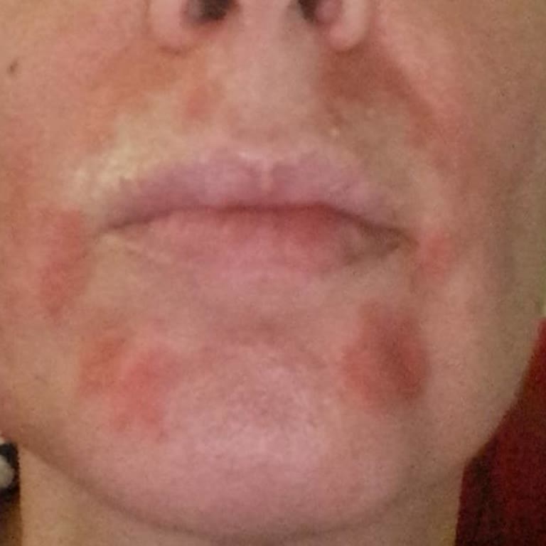 Pofu Islak Mendilinde Yüz Yaraları Ve Şiddetli Kaşıntı