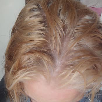 Yıllardır Kullandığım Saç Boyası Ani Renk Bozulmasıyla Kırmızıya Dönüştü, Acil Yardım Bekliyorum