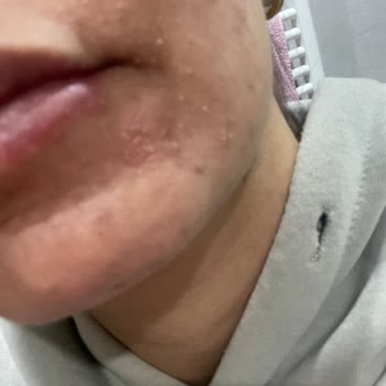 Neutrogena Yüz Yıkama Jeli Kullanımında Cilt Yanması ve Tahrişi