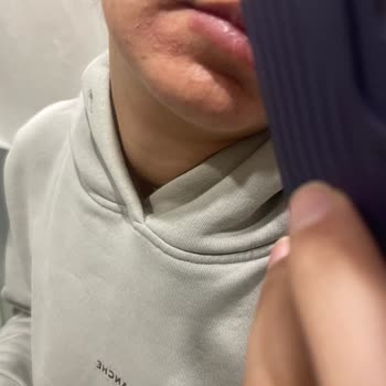 Neutrogena Yüz Yıkama Jeli Kullanımında Cilt Yanması ve Tahrişi