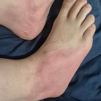 Gratis Ayak Maskesinden Şiddetli Kızarıklık Ve Kaşıntı İade Ve Tazminat Talebi