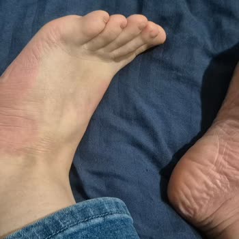 Gratis Ayak Maskesinden Şiddetli Kızarıklık Ve Kaşıntı İade Ve Tazminat Talebi