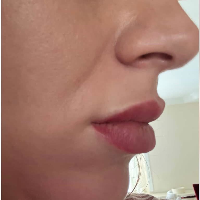 Yanıltıcı Reklam Ve Asimetrik Dudak Dolgusu Nedeniyle İade Talebi