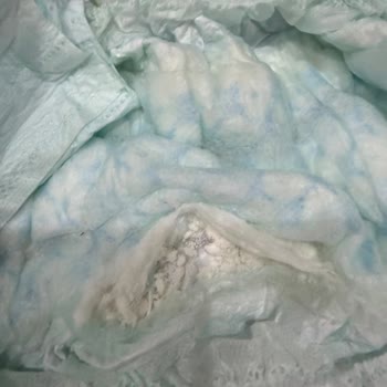 Prima Bebek Bezinde Kireç Benzeri Sert Parçacıklar Ve Sağlık Riski