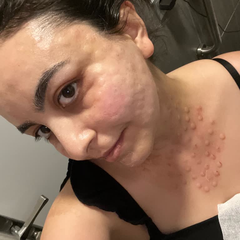 Gentek Kök Hücre Tedavisinde Ağrı Şişlik, Alerji Ve Etkisizlik Şikayeti