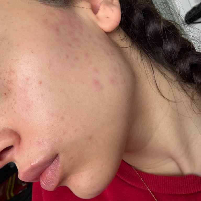 Bee Beauty Ağda Bandı Yüzümde Şiddetli Tahriş Ve Yanma Yarattı