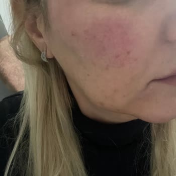 Dr. Gökhan Ceviz Kızarıklık Ve Yanma Şikayetleri Oluştu