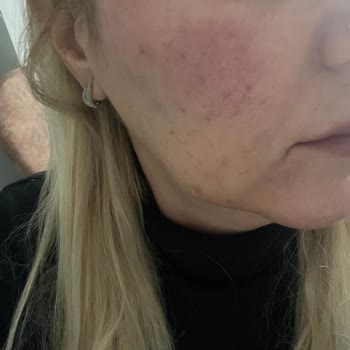 Dr. Gökhan Ceviz Kızarıklık Ve Yanma Şikayetleri Oluştu