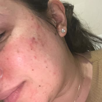 Caudalie Vinoperfect Ürünü Cilt Reaksiyonu Yarattı Sağlık Bakanlığı İncelemesi Talep Ediliyor