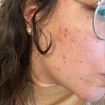 Caudalie Vinoperfect Ürünü Cilt Reaksiyonu Yarattı Sağlık Bakanlığı İncelemesi Talep Ediliyor