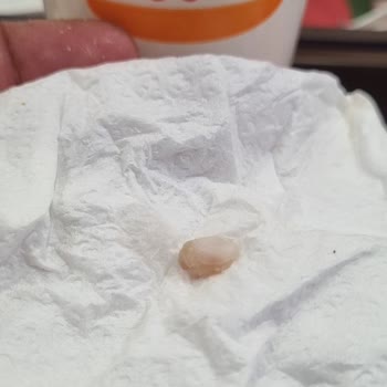 Burger King Tavuk Burgerinde Kemik Parçası Şikayeti