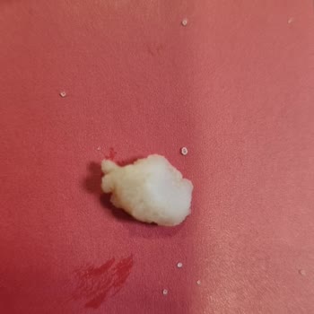 Burger King Tavuk Burgerinde Kemik Parçası Şikayeti