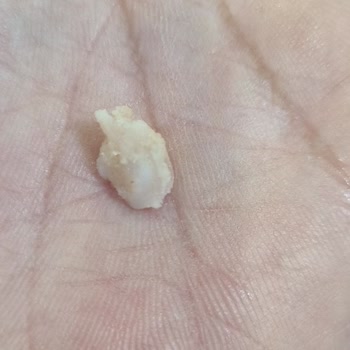 Burger King Tavuk Burgerinde Kemik Parçası Şikayeti