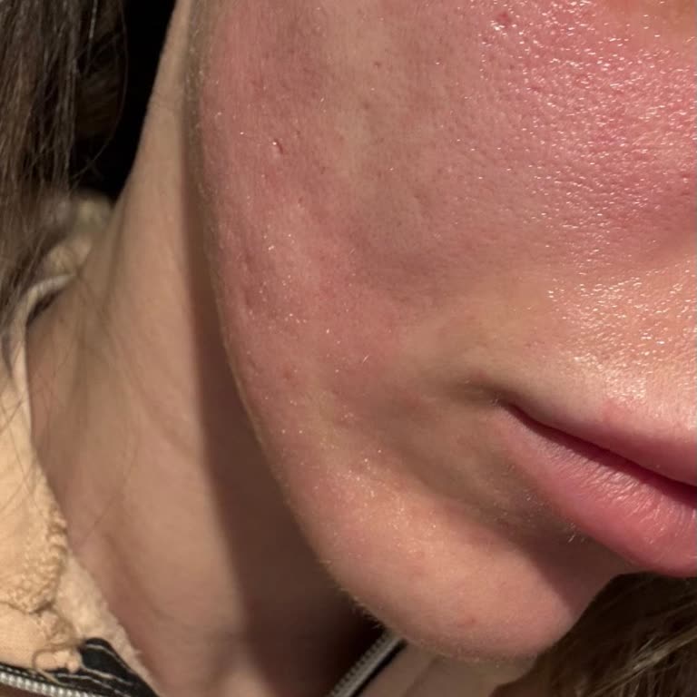 Bayer Madecasol Kremi Yüzümde Ani Yanma Ve Yanık Oluşturdu