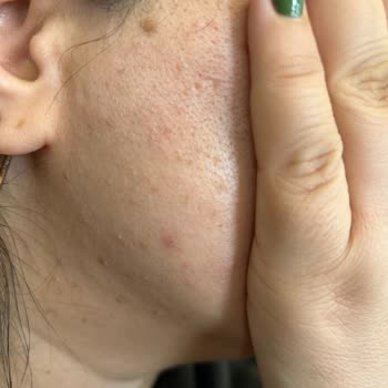 Bioderma Sebium Sensitive Ürünü Cildimde Soyulma Ve Sivilcelere Neden Olduğundan Mağdur Oldum