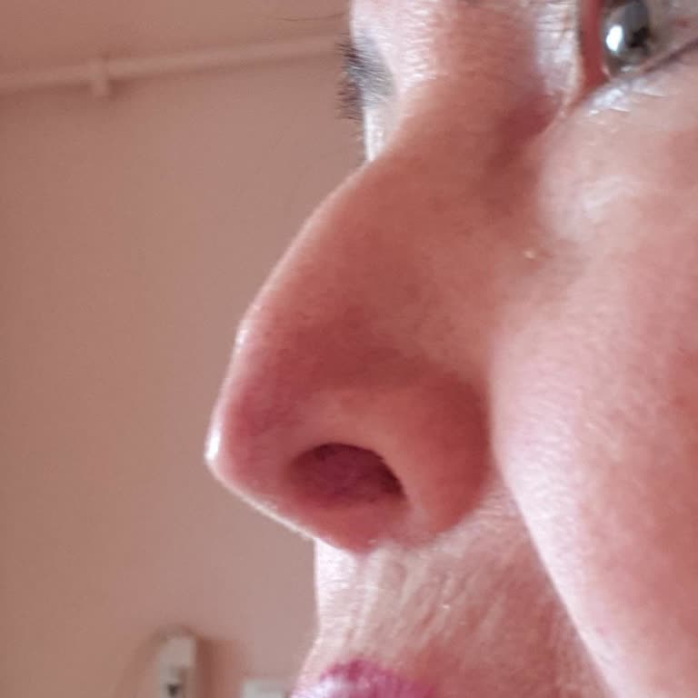 Kırık Burun Kemik Ve Estetik Bozukluğu Sonrası Hastane Çözüm Sunmadı: Masrafların Karşılanması Talep Ediliyor