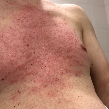 Agiss Cilt Yanması Ve Kabarması