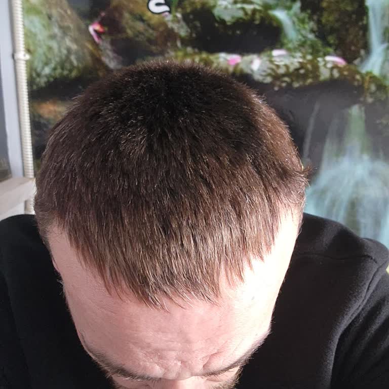 Kalitesiz Saç Protezi Ve Hızlı Renk Solması